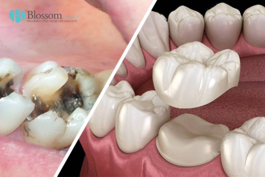 Cách làm chết tủy răng tại nhà có an toàn không? Giải pháp tạm thời và rủi ro 6 cach lam chet tuy rang tai nha 6 min