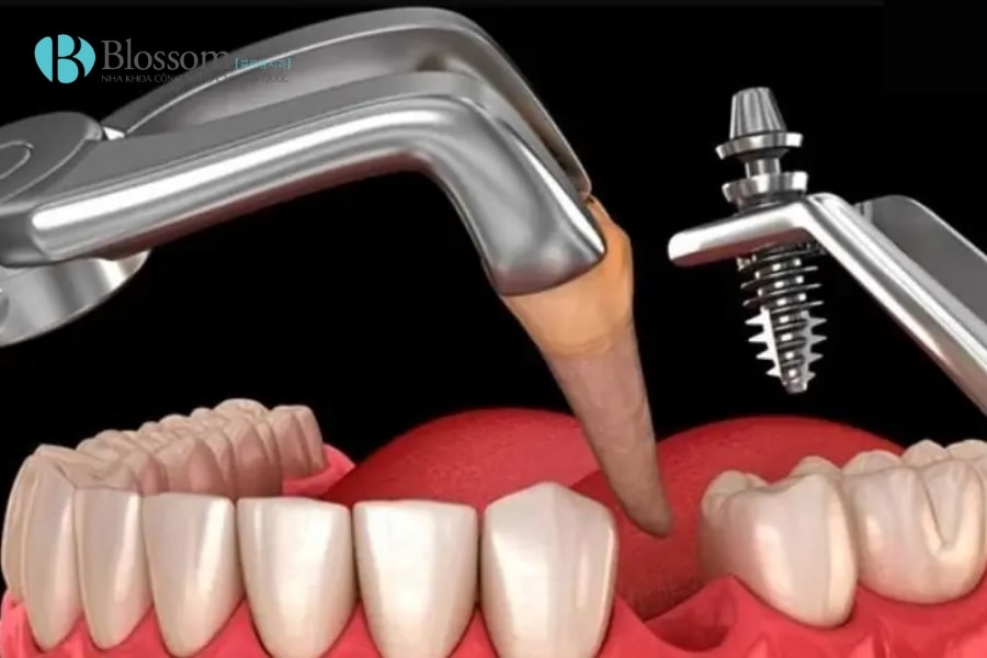 Cách làm chết tủy răng tại nhà có an toàn không? Giải pháp tạm thời và rủi ro 7 cach lam chet tuy rang tai nha 7 min