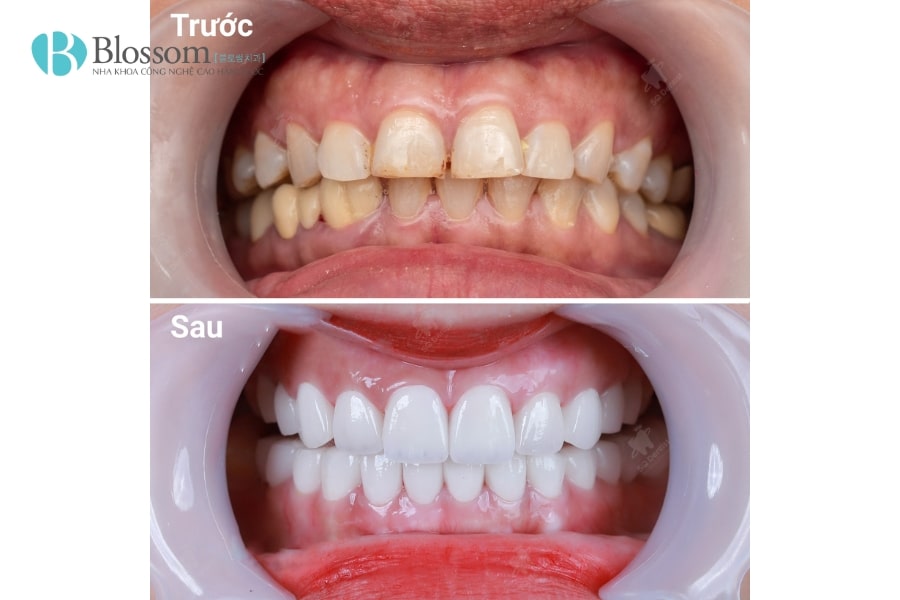 Dán Sứ Không Mài Có Đắt Không? Có Nên Dán Sứ Không Mài Lamifilm? 3 dan su khong mai co dat khong 3 min