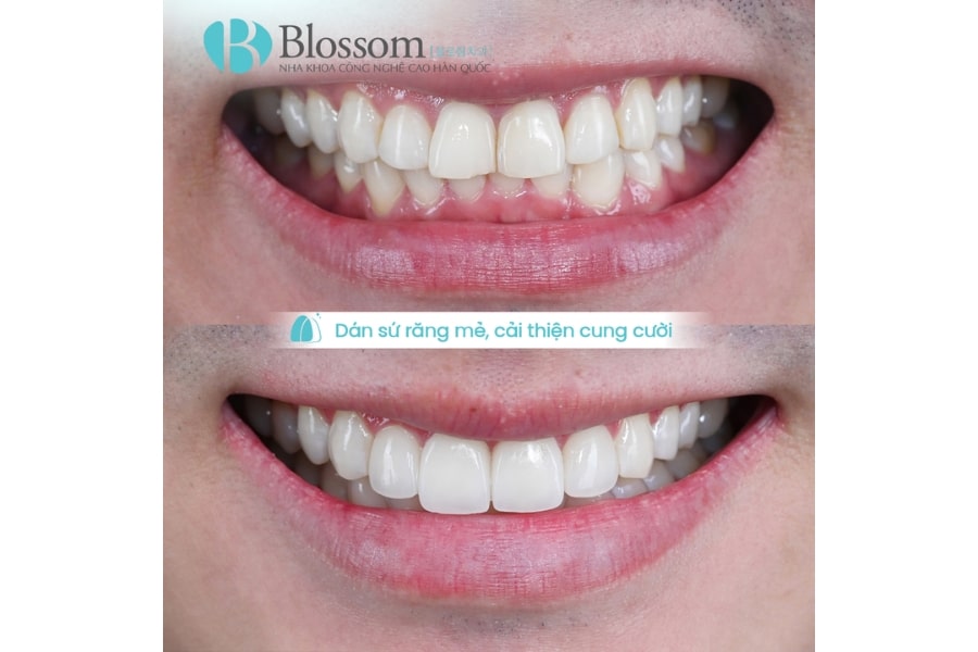 Dán Sứ Không Mài Có Đắt Không? Có Nên Dán Sứ Không Mài Lamifilm? 5 dan su khong mai co dat khong 5 min