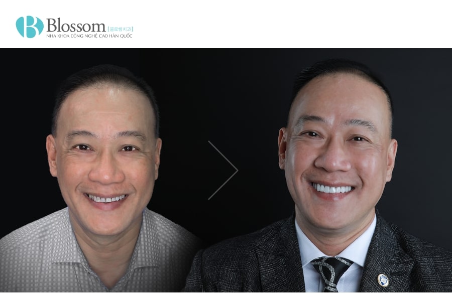 Dán Sứ Không Mài Có Đắt Không? Có Nên Dán Sứ Không Mài Lamifilm? 6 dan su khong mai co dat khong 6 min