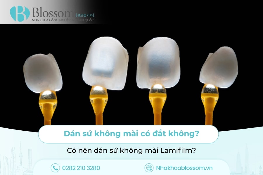 Dán Sứ Không Mài Có Đắt Không? Có Nên Dán Sứ Không Mài Lamifilm?