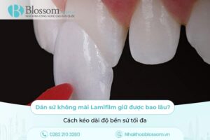 Dán sứ không mài Lamifilm giữ được bao lâu? Cách kéo dài độ bền sứ tối đa