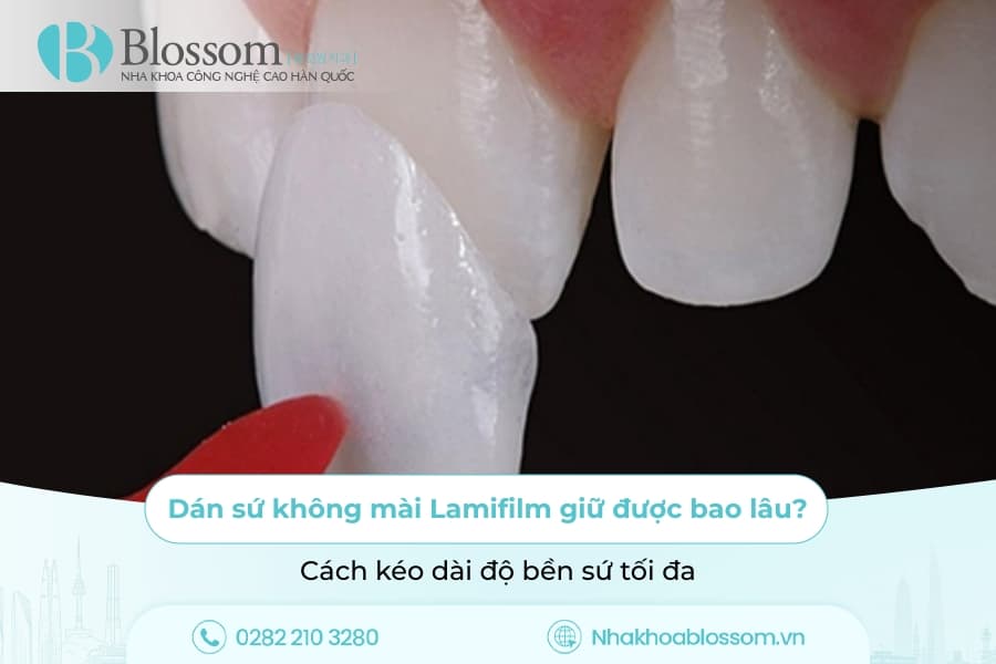 Dán sứ không mài Lamifilm giữ được bao lâu? Cách kéo dài độ bền sứ tối đa