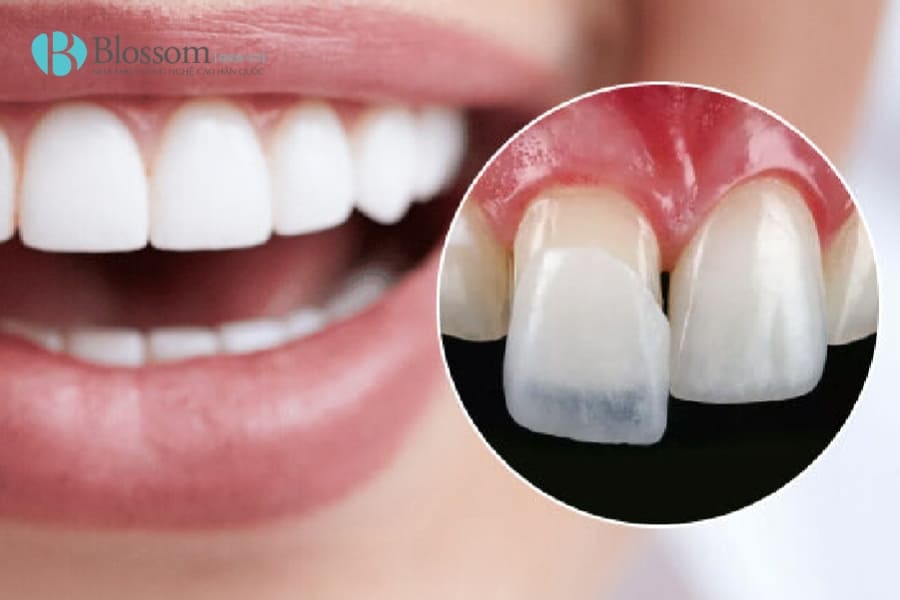 dan su veneer gay hoi mieng 1 min 1