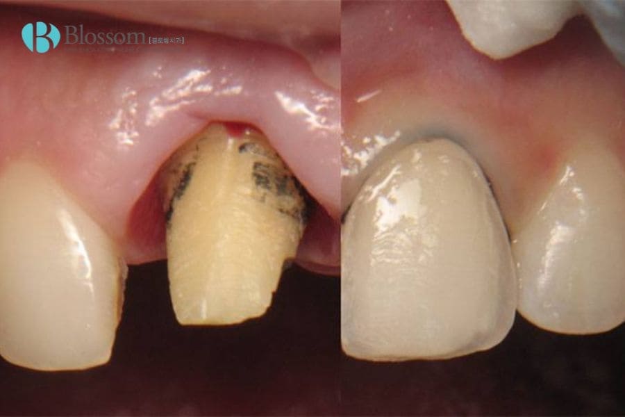 dan su veneer gay hoi mieng 2 min 1