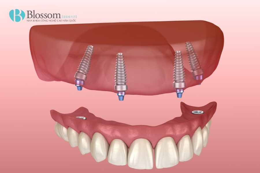 Hàm tháo lắp trên Implant: Giải pháp phục hình hiệu quả và thẩm mỹ 1 ham thao lap tren implant 1 min