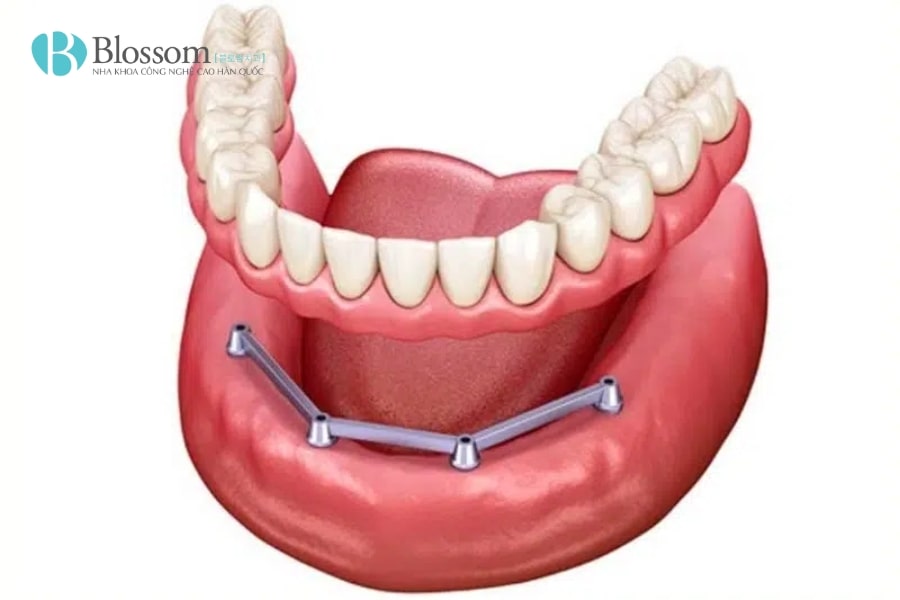 Hàm tháo lắp trên Implant: Giải pháp phục hình hiệu quả và thẩm mỹ 2 ham thao lap tren implant 2 min