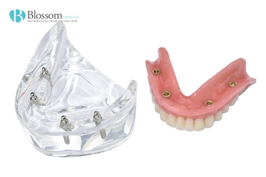 Hàm tháo lắp trên Implant: Giải pháp phục hình hiệu quả và thẩm mỹ 3 ham thao lap tren implant 3 min