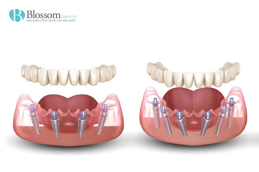 Hàm tháo lắp trên Implant: Giải pháp phục hình hiệu quả và thẩm mỹ 4 ham thao lap tren implant 4 min