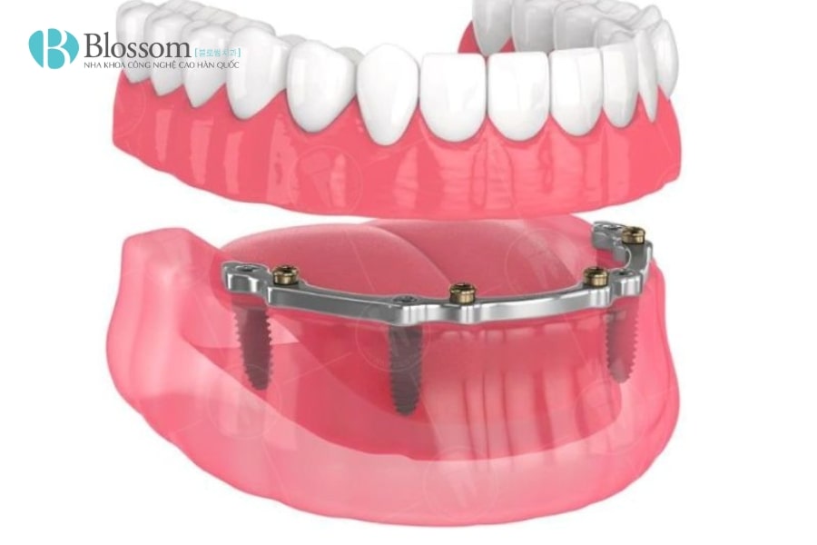 Hàm tháo lắp trên Implant: Giải pháp phục hình hiệu quả và thẩm mỹ 5 ham thao lap tren implant 6 min