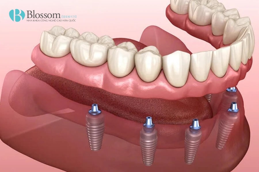 Hàm tháo lắp trên Implant: Giải pháp phục hình hiệu quả và thẩm mỹ 6 ham thao lap tren implant 7 min