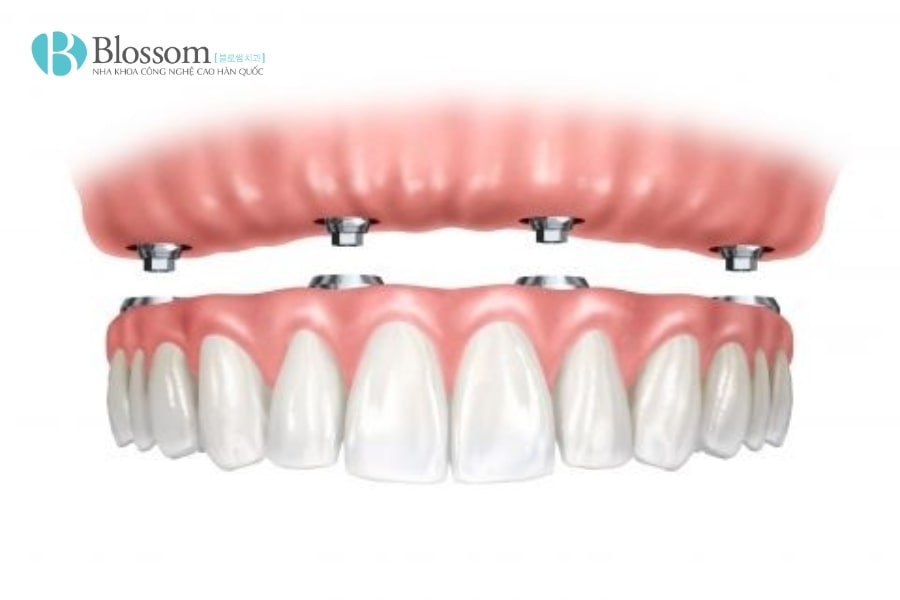 Hàm tháo lắp trên Implant: Giải pháp phục hình hiệu quả và thẩm mỹ 7 ham thao lap tren implant 8 min