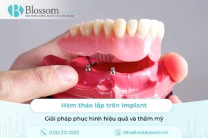 Hàm tháo lắp trên Implant: Giải pháp phục hình hiệu quả và thẩm mỹ