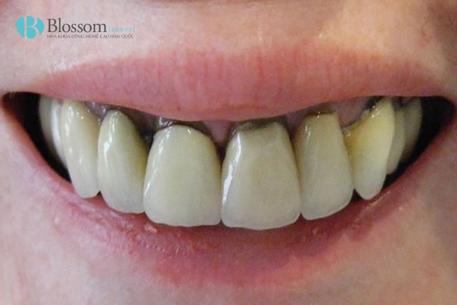 Hậu quả khi làm răng sứ giá rẻ: Những rủi ro bạn cần biết trước khi thực hiện 1 hau qua khi lam rang su gia re 1 min 1