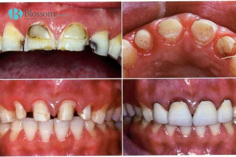 Hậu quả khi làm răng sứ giá rẻ: Những rủi ro bạn cần biết trước khi thực hiện 3 hau qua khi lam rang su gia re 3 min 1