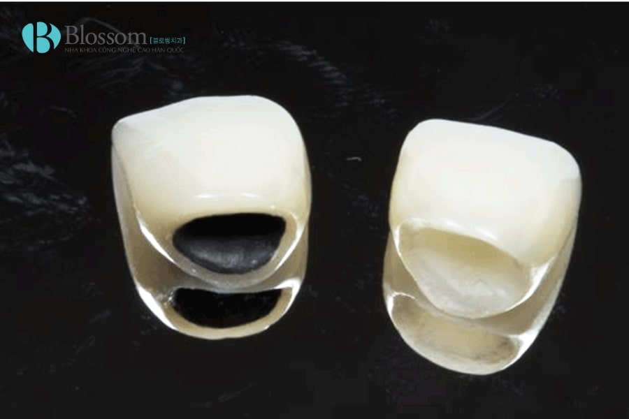 Hậu quả khi làm răng sứ giá rẻ: Những rủi ro bạn cần biết trước khi thực hiện 4 hau qua khi lam rang su gia re 4 min 1