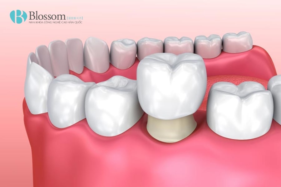 Hậu quả khi làm răng sứ giá rẻ: Những rủi ro bạn cần biết trước khi thực hiện 5 hau qua khi lam rang su gia re 5 min 1