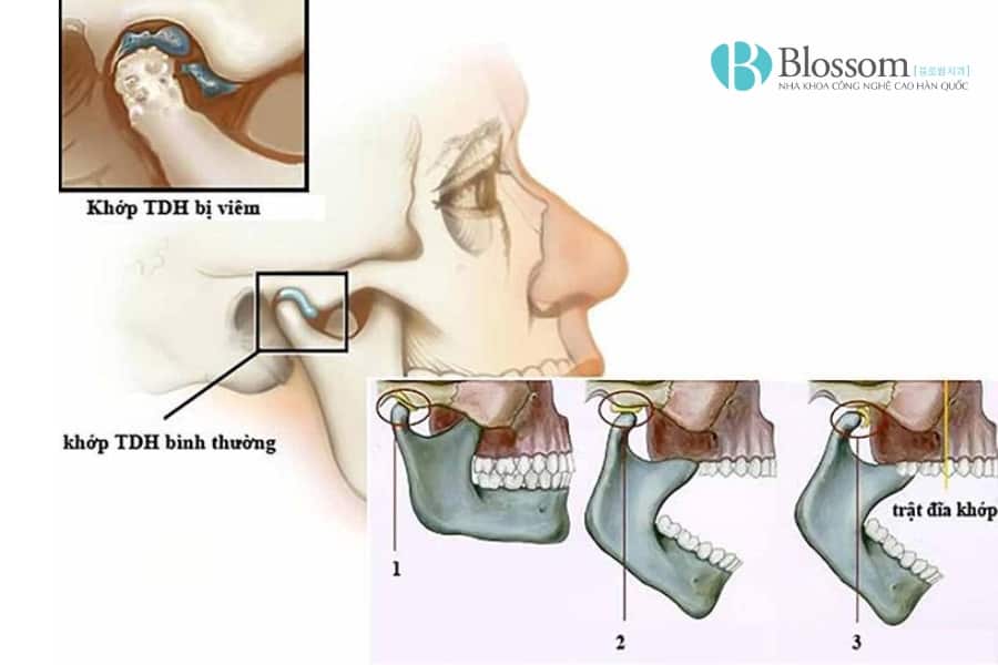 khop thai duong ham co nieng duoc khong 2 min