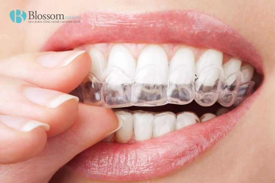 khop thai duong ham co nieng duoc khong 5 min