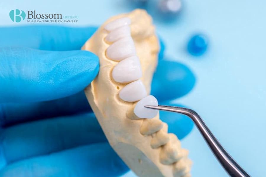 Quy trình chế tác răng sứ diễn ra như thế nào? Từ công nghệ phổ biến đến kỹ thuật chế tác thủ công cao cấp 1 quy trinh che tac rang su 1 min