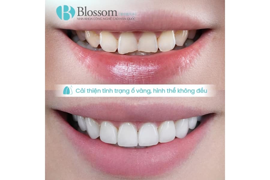 Quy trình chế tác răng sứ diễn ra như thế nào? Từ công nghệ phổ biến đến kỹ thuật chế tác thủ công cao cấp 10 quy trinh che tac rang su 10 min