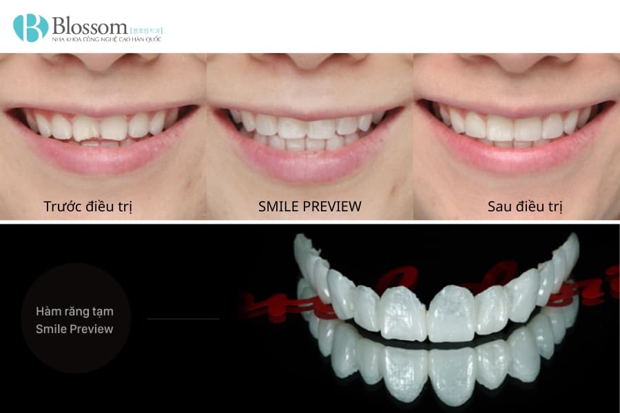 Quy trình chế tác răng sứ diễn ra như thế nào? Từ công nghệ phổ biến đến kỹ thuật chế tác thủ công cao cấp 6 quy trinh che tac rang su 6 min
