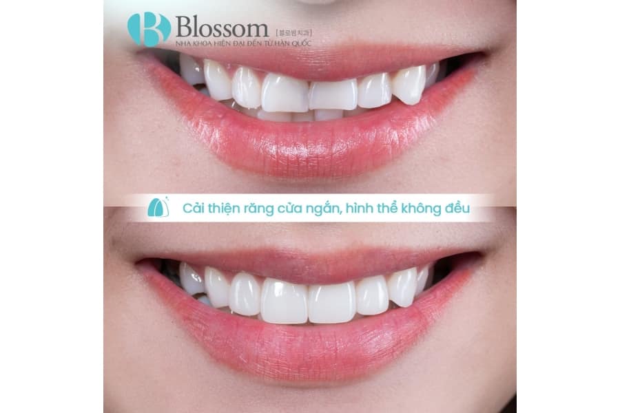 Quy trình chế tác răng sứ diễn ra như thế nào? Từ công nghệ phổ biến đến kỹ thuật chế tác thủ công cao cấp 7 quy trinh che tac rang su 9 min