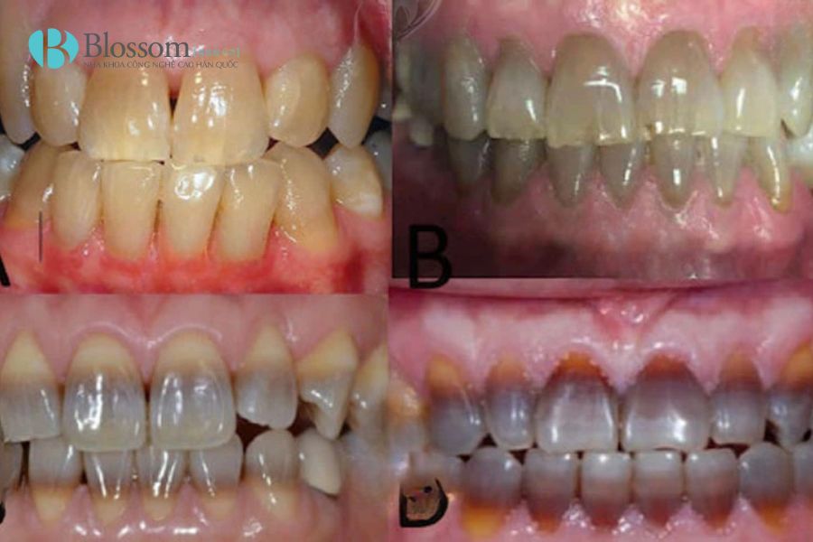 Răng nhiễm màu có dán sứ không mài được không? Tiêu chí đánh giá & giải pháp xử lý 1 rang nhiem mau co dan su khong mai duoc khong 1