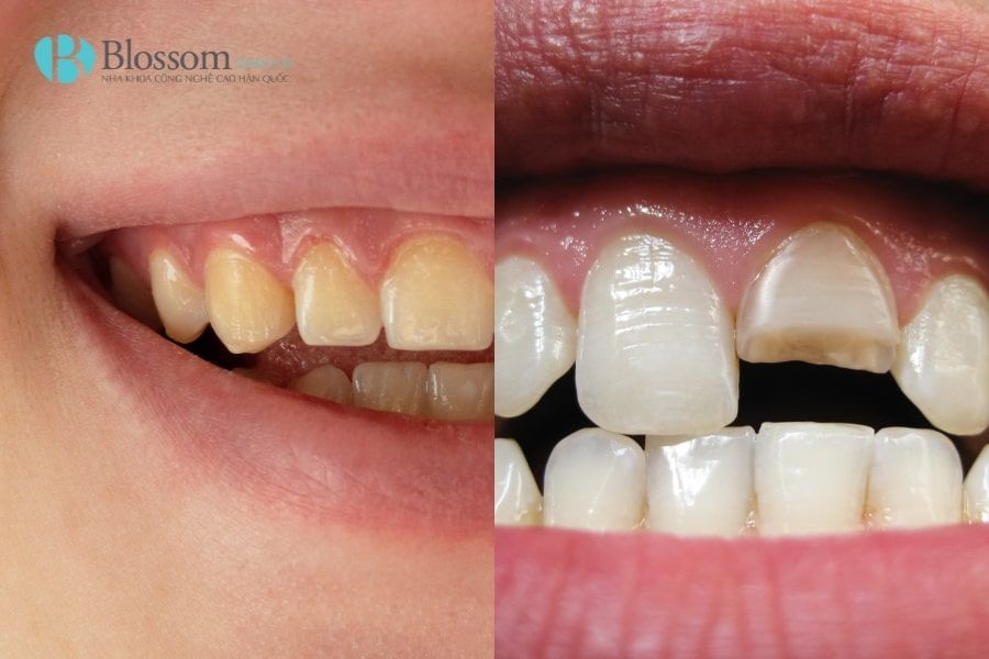 Răng nhiễm màu có dán sứ không mài được không? Tiêu chí đánh giá & giải pháp xử lý 2 rang nhiem mau co dan su khong mai duoc khong 2 1