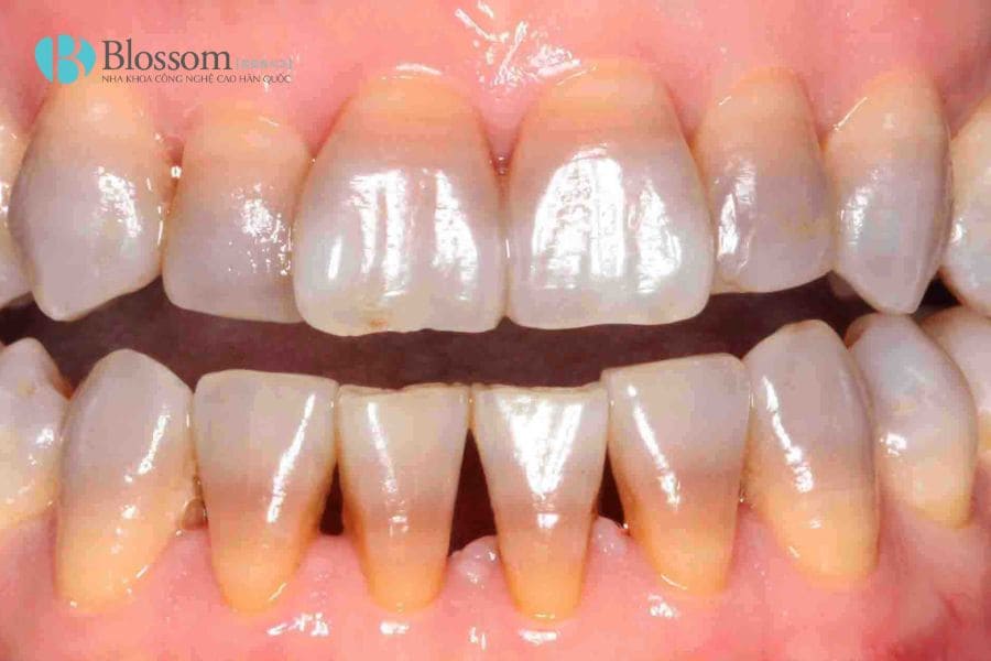Răng nhiễm màu có dán sứ không mài được không? Tiêu chí đánh giá & giải pháp xử lý 3 rang nhiem mau co dan su khong mai duoc khong 3 1