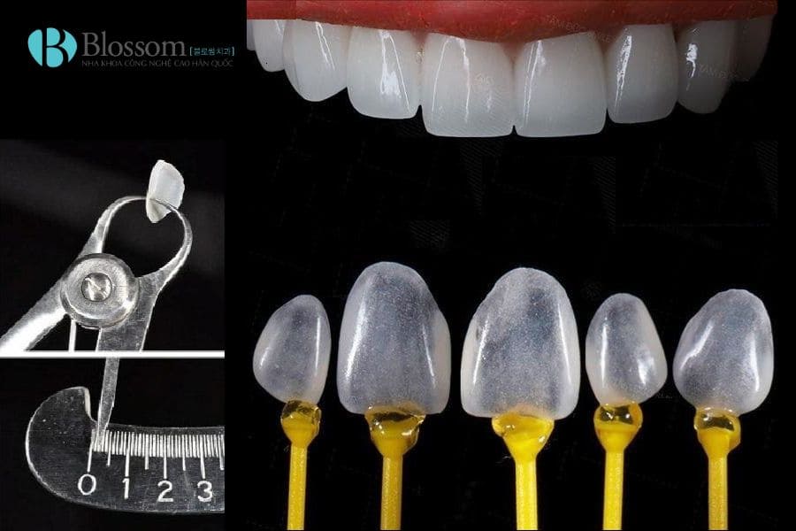 Răng nhiễm màu có dán sứ không mài được không? Tiêu chí đánh giá & giải pháp xử lý 4 rang nhiem mau co dan su khong mai duoc khong 4 1