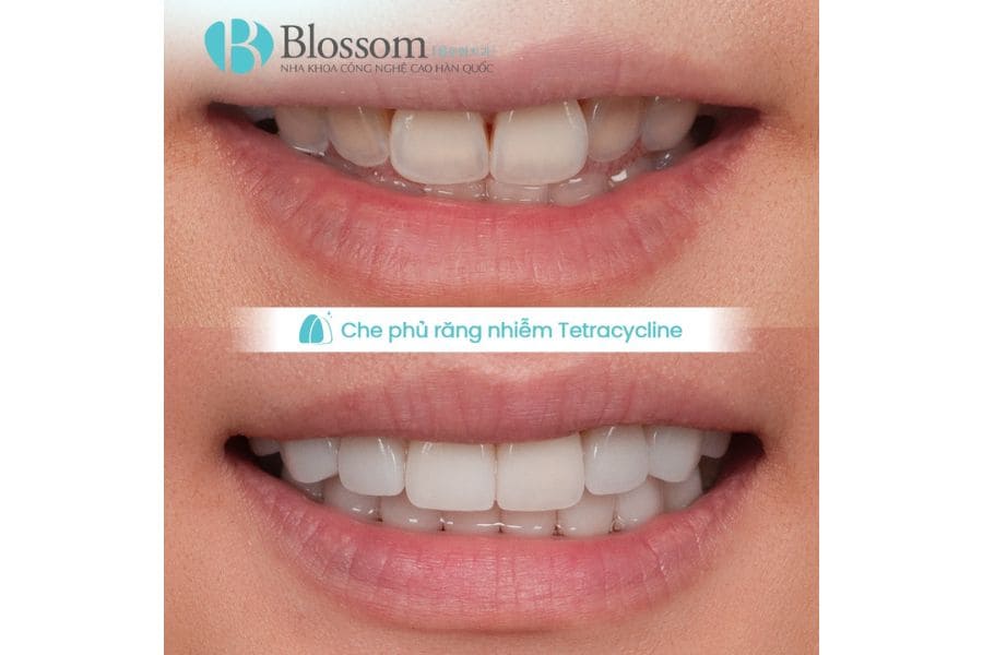 Răng nhiễm màu có dán sứ không mài được không? Tiêu chí đánh giá & giải pháp xử lý 5 rang nhiem mau co dan su khong mai duoc khong 5 1