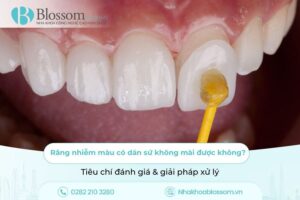 Răng nhiễm màu có dán sứ không mài được không? Tiêu chí đánh giá & giải pháp xử lý
