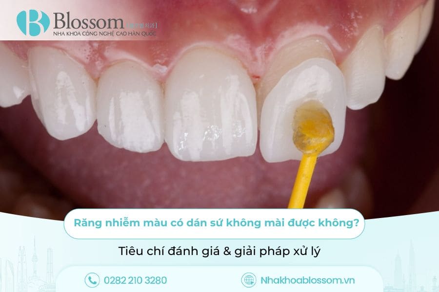 Răng nhiễm màu có dán sứ không mài được không? Tiêu chí đánh giá & giải pháp xử lý