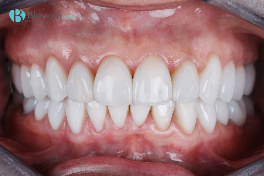 Review dán sứ không mài Lamifilm: Có thật sự bền và tốt như lời đồn? 4 review dan su khong mai lamifilm 4 min