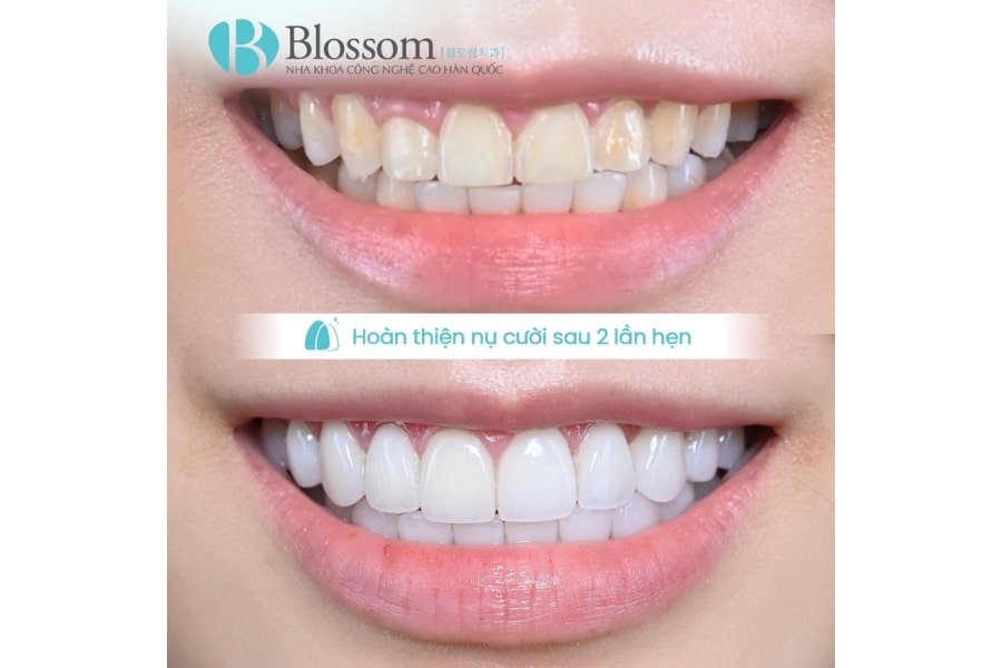 Review dán sứ không mài Lamifilm: Có thật sự bền và tốt như lời đồn? 9 review dan su khong mai lamifilm 9 min