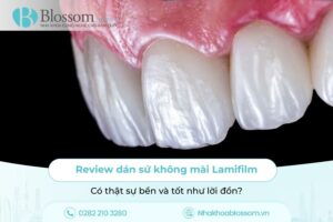 Review dán sứ không mài Lamifilm: Có thật sự bền và tốt như lời đồn?