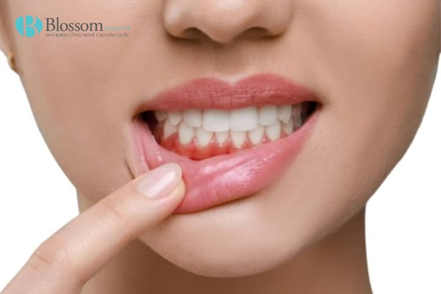 Cảm giác thường gặp sau khi làm răng sứ: Bình thường hay dấu hiệu biến chứng? 2 cam giac thuong gap sau khi lam rang su 2 2