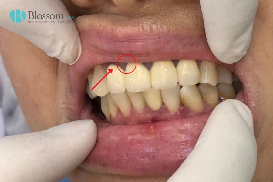 Cảm giác thường gặp sau khi làm răng sứ: Bình thường hay dấu hiệu biến chứng? 3 cam giac thuong gap sau khi lam rang su 3 2