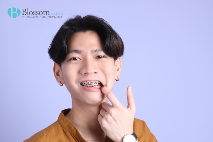 da lam rang su roi co nieng duoc khong 1