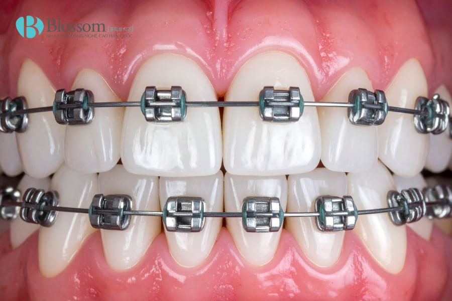 da lam rang su roi co nieng duoc khong 3