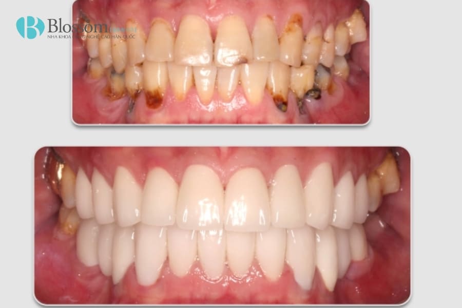 da lam rang su roi co nieng duoc khong 5