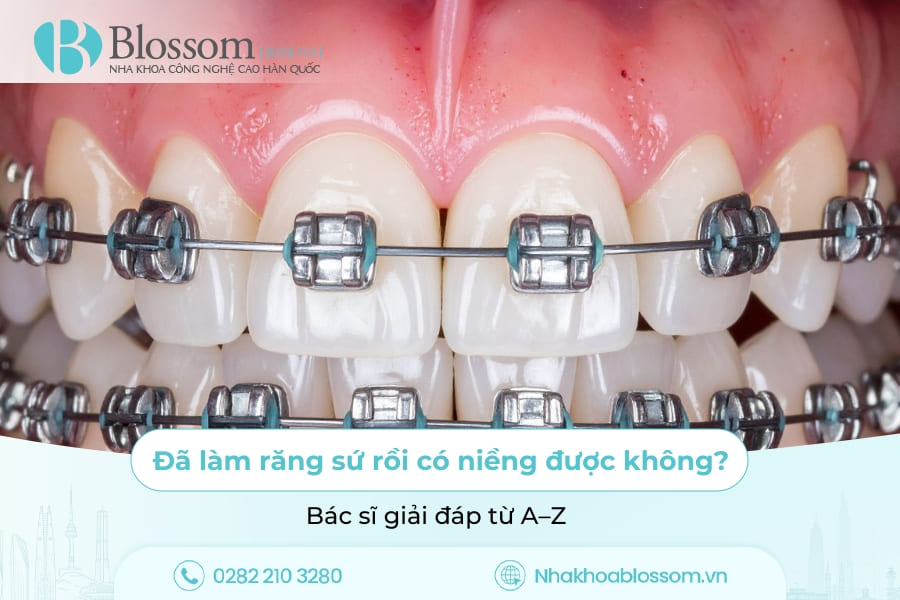 Đã làm răng sứ rồi có niềng được không? Bác sĩ giải đáp từ A–Z
