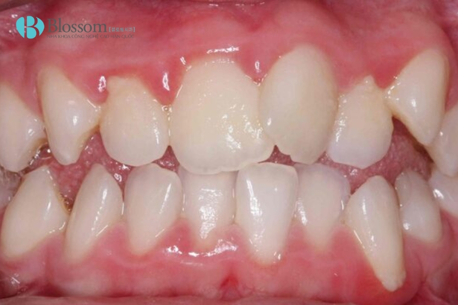 Răng Mọc Lộn Xộn Có Dán Sứ Không Mài Được Không? 1 rang moc lon xon co dan su khong mai duoc khong 1