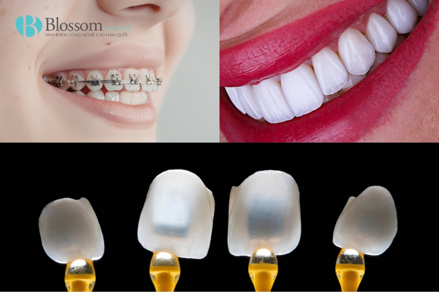 Răng Mọc Lộn Xộn Có Dán Sứ Không Mài Được Không? 2 rang moc lon xon co dan su khong mai duoc khong 2