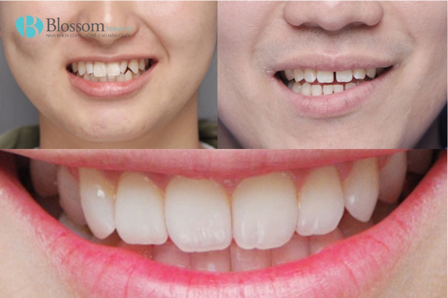 Răng Mọc Lộn Xộn Có Dán Sứ Không Mài Được Không? 3 rang moc lon xon co dan su khong mai duoc khong 3