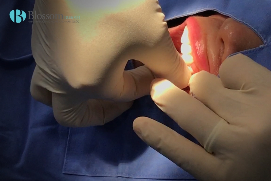 Răng Mọc Lộn Xộn Có Dán Sứ Không Mài Được Không? 5 rang moc lon xon co dan su khong mai duoc khong 5