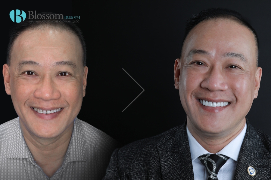 Răng Mọc Lộn Xộn Có Dán Sứ Không Mài Được Không? 6 rang moc lon xon co dan su khong mai duoc khong 6