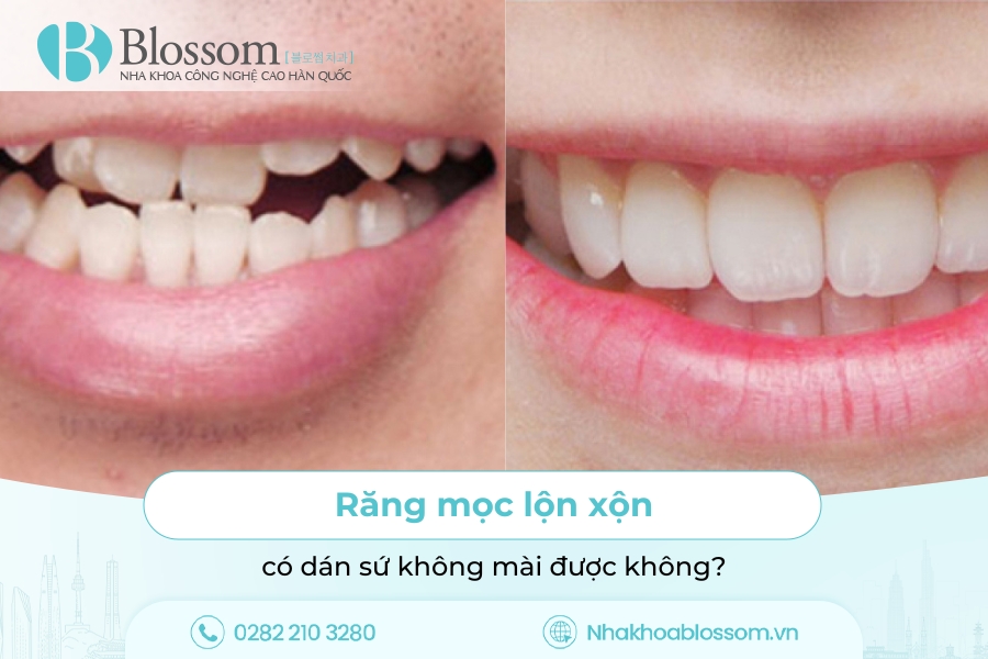Răng Mọc Lộn Xộn Có Dán Sứ Không Mài Được Không?